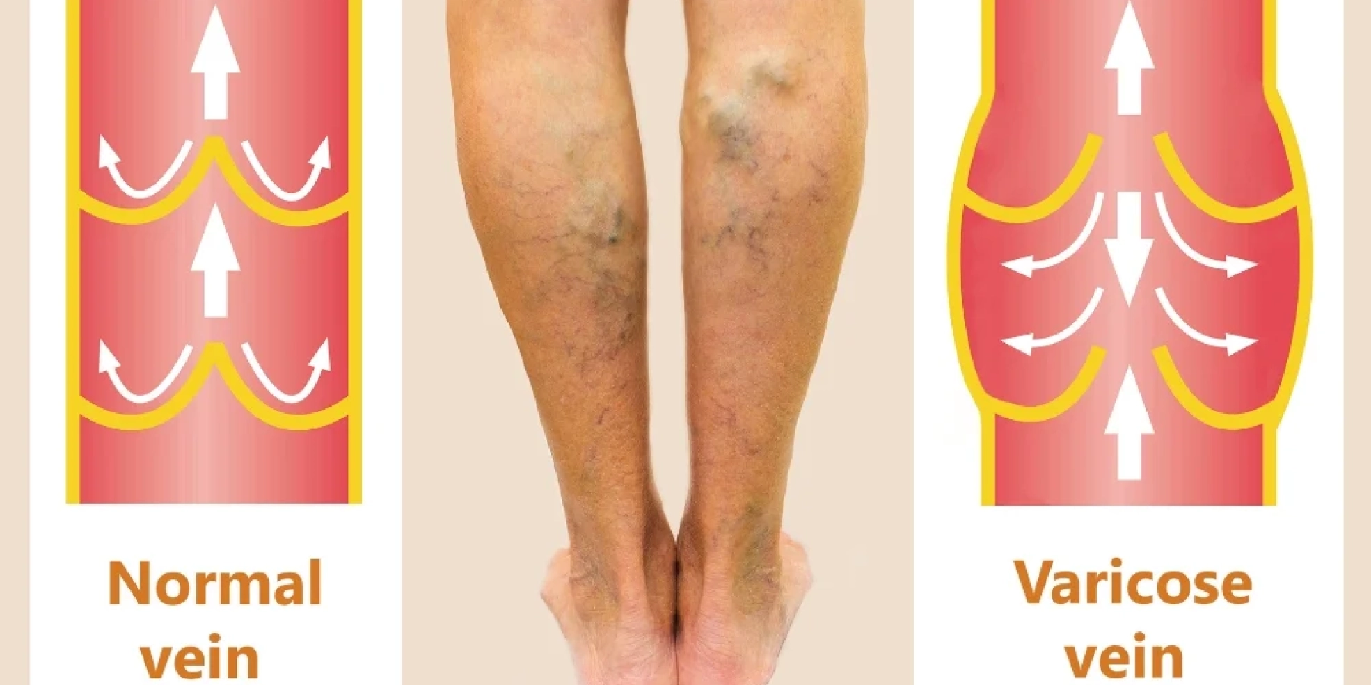Varicose Veins