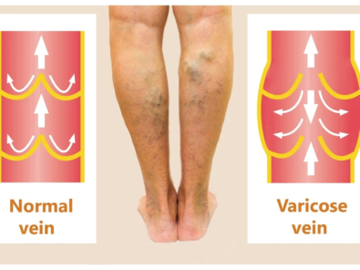 Varicose Veins