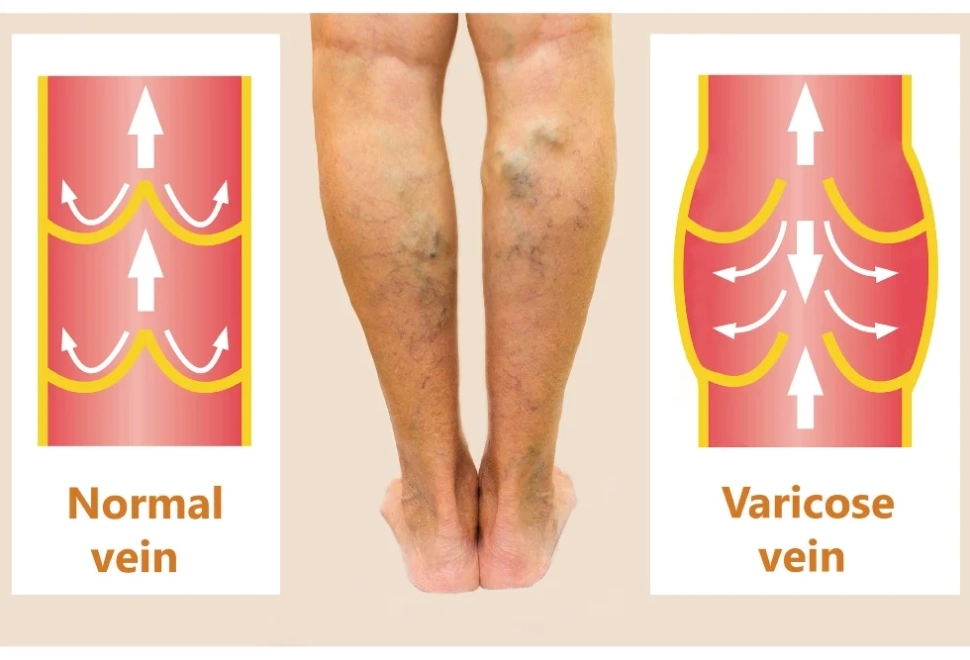 Varicose Veins