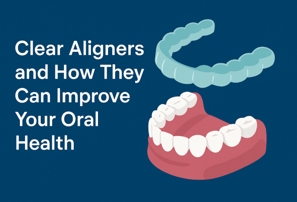 clear aligners