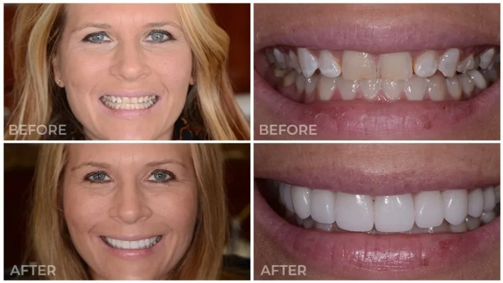 Porcelain Veneers