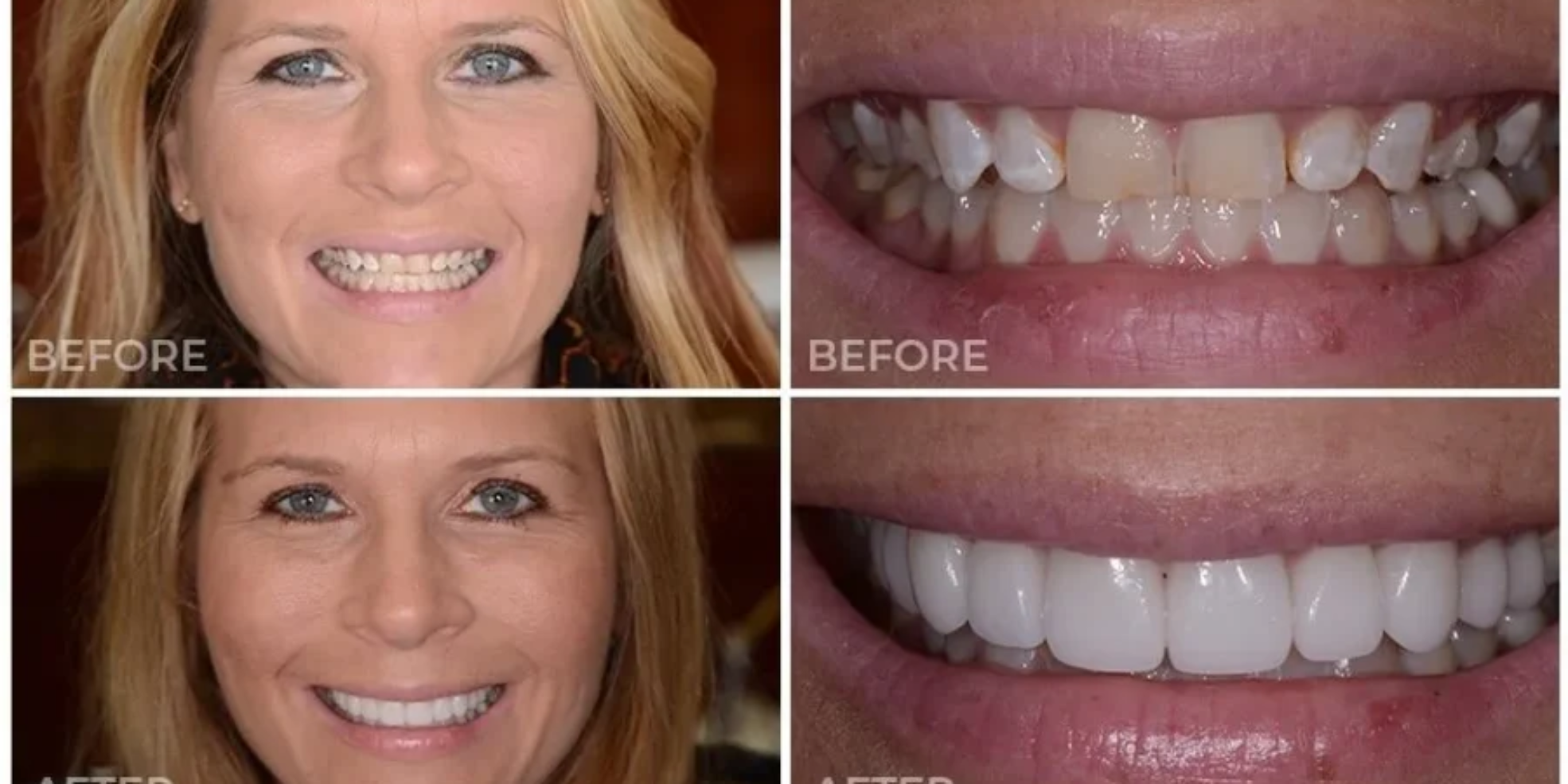 Porcelain Veneers