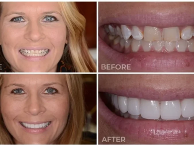 Porcelain Veneers