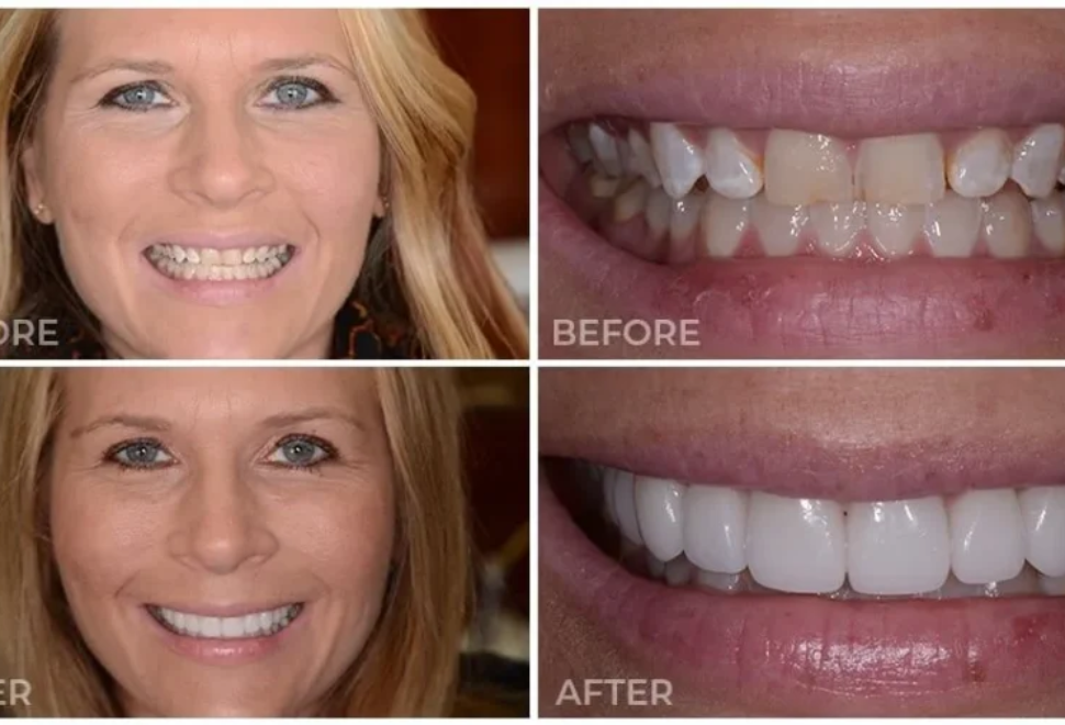 Porcelain Veneers